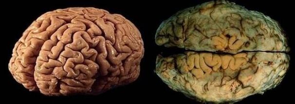 mózg zdrowej i pijącej osoby